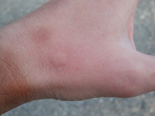 sandfly bite 